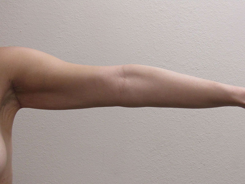 Arm Lift Procedures Remedy Saggy Arms