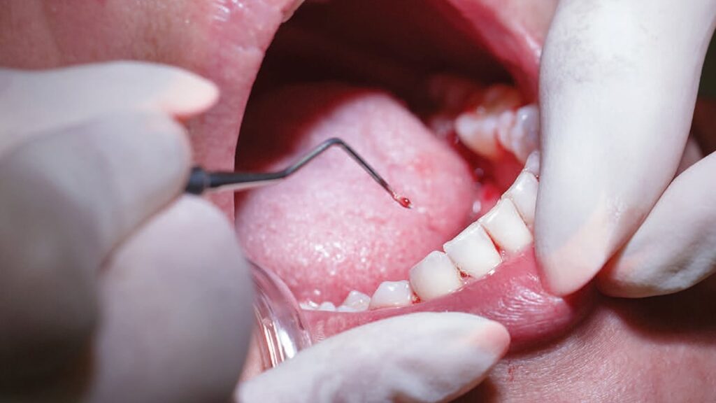Step-by-Step Guide to Plasmolifting in Periodontal Disease Therapy