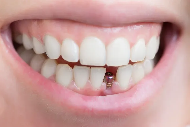 The Basics of Endosteal Dental Implants in Drexel Hill